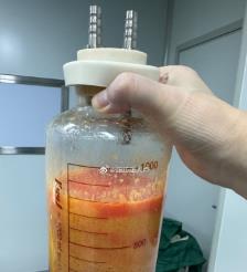 招远水动力吸脂手术要做多久？